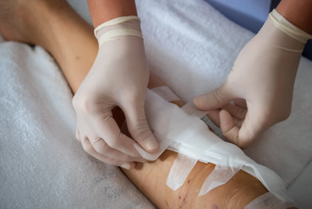 Enfermeira aplicando bandagens na perna do paciente operado
